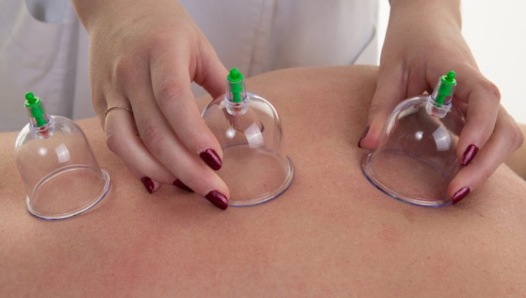 همه چیز درباره حجامت