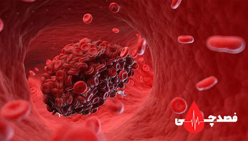 بهترین زمان فصد خون